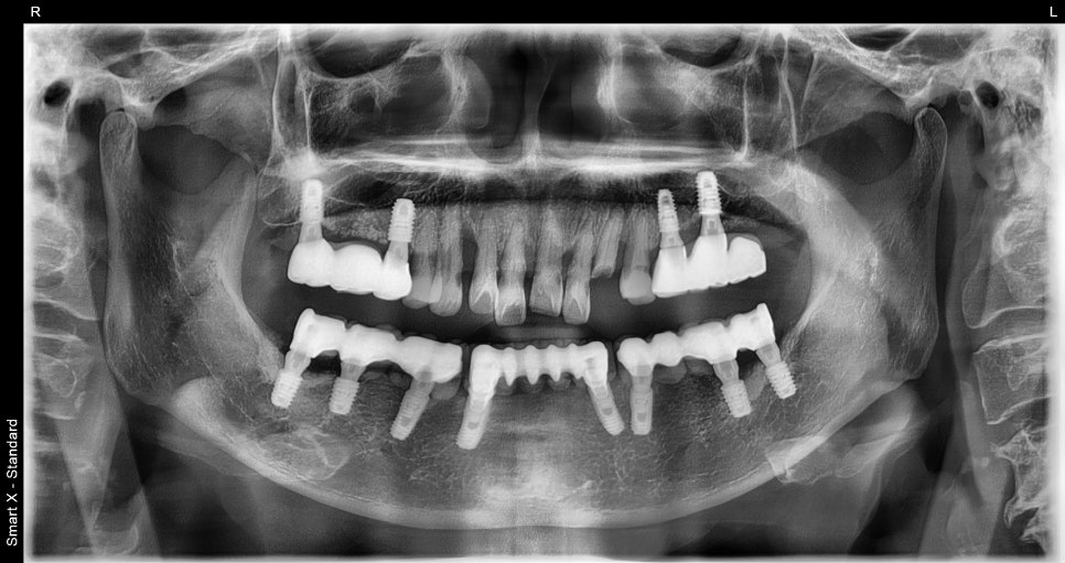 앞니 임플란트, 전치부 심미까지 살린 치료 과정 정리 관련 이미지 3