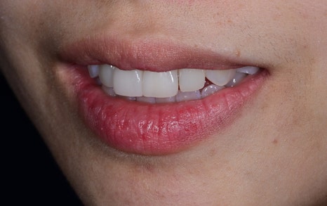 Laminate Veneers for Protruding Teeth: If They’re Too Thick, They Look Even More Prominent image 3