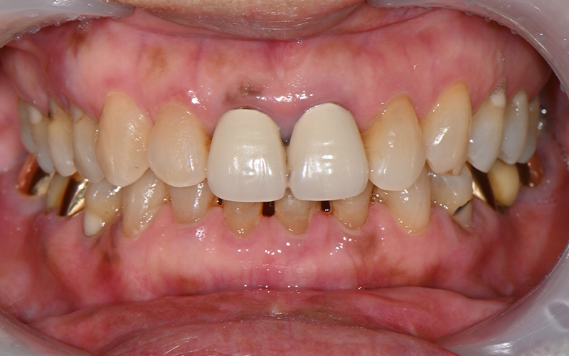 [Seokchon Gobun Station Dental Clinic] When Is an Implant Needed? image 2