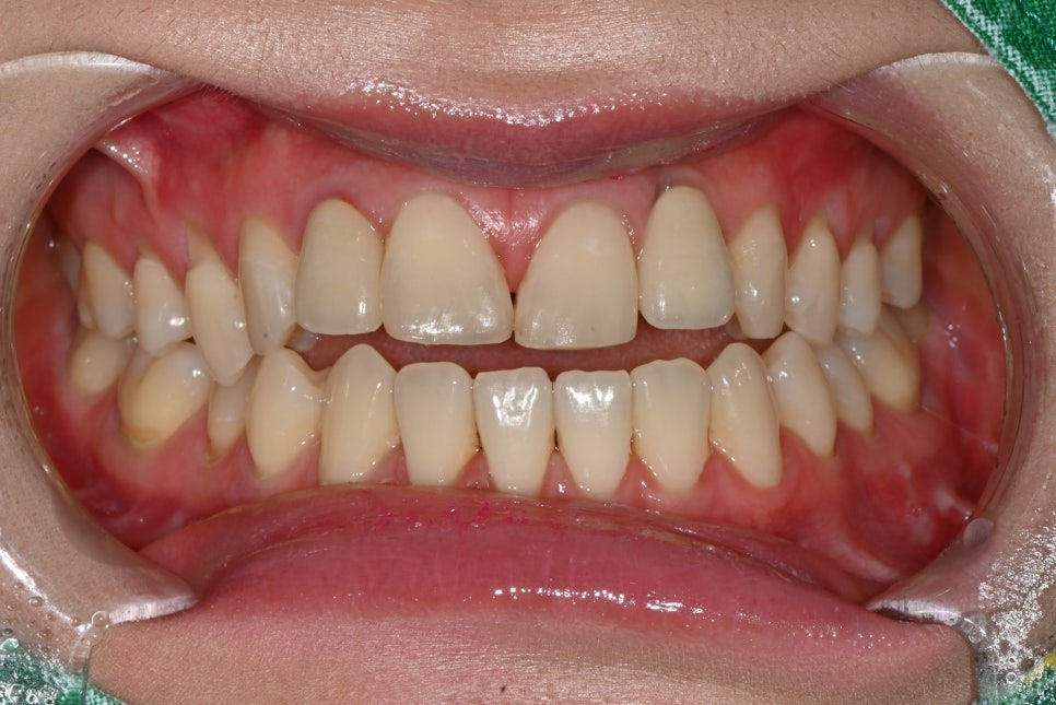 A Case of Simultaneous Laminate and Implant Prosthetic Treatment image 2