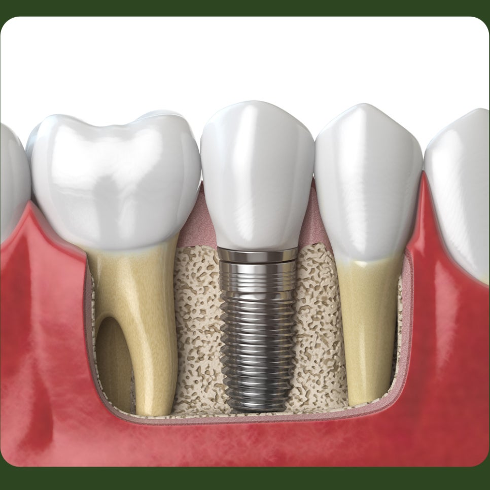 Implant Care Needs Special Attention! image 3