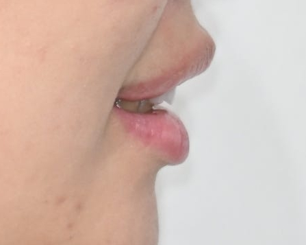 Jamsil Veneers: Worried About Rabbit Teeth? image 15