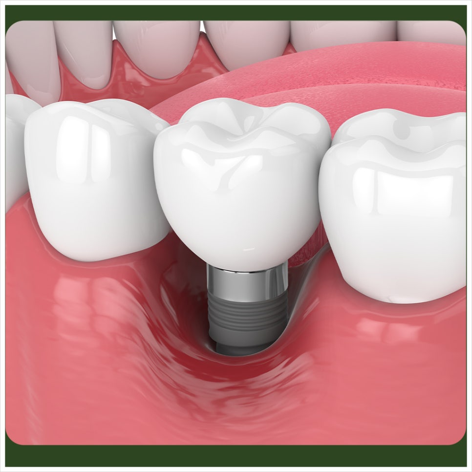 What Should I Do If My Implant Feels Loose? image 3
