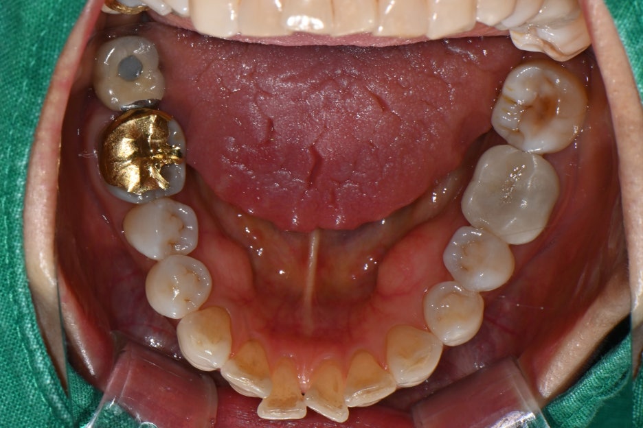 Songpa Dental Clinic: Is Insurance-Covered Implant Treatment Possible? image 11