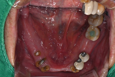 If Your Denture Keeps Coming Loose, What Should You Do? A Real Case Solved with Insurance-Covered Implant Dentures image 5