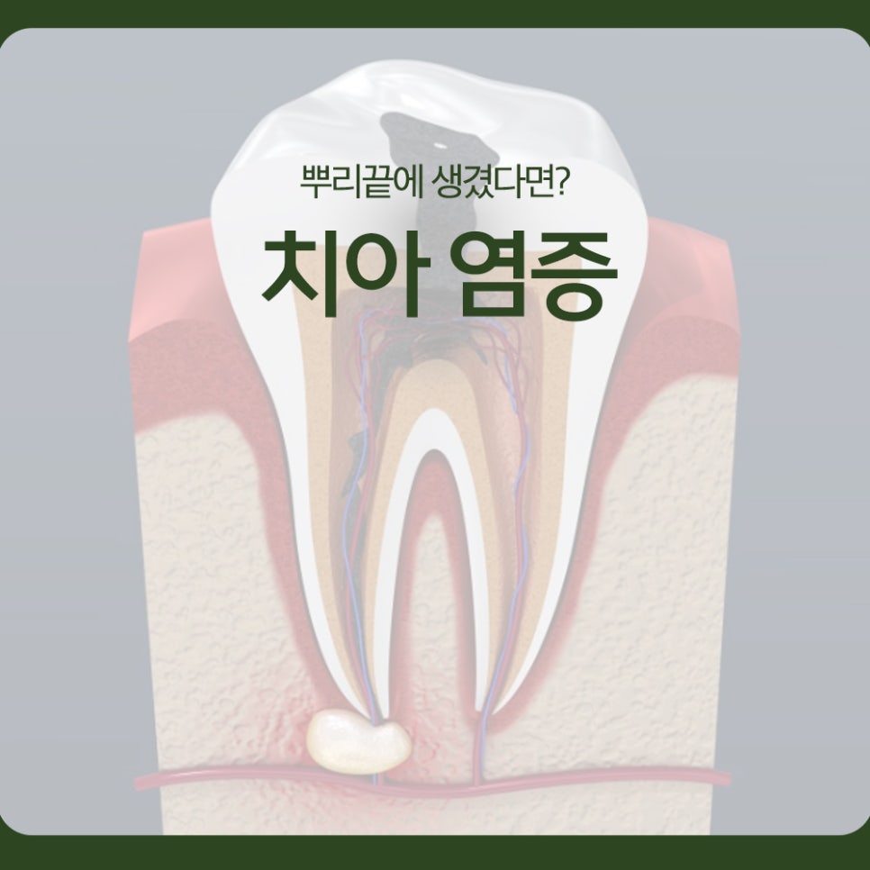 치아 염증, 뿌리끝에 생겼다면? 관련 이미지 1