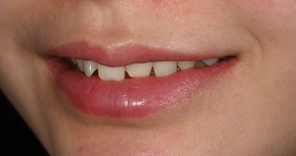 Tooth Wear: Resin? Veneers Are Also an Option image 4