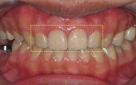 Why Is Sinus Lift Surgery Needed? image 2