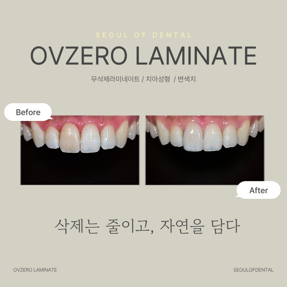 오브제로 라미네이트로 앞니 변색 고민 해결한 실제 사례 관련 이미지 1