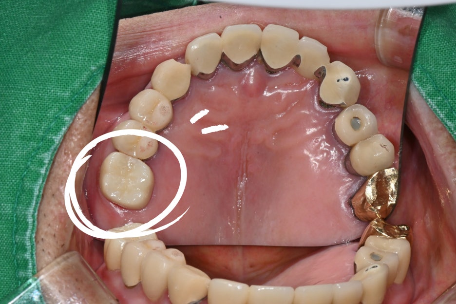 Why the First Root Canal Procedure Must Be Handled by a Specialist image 9