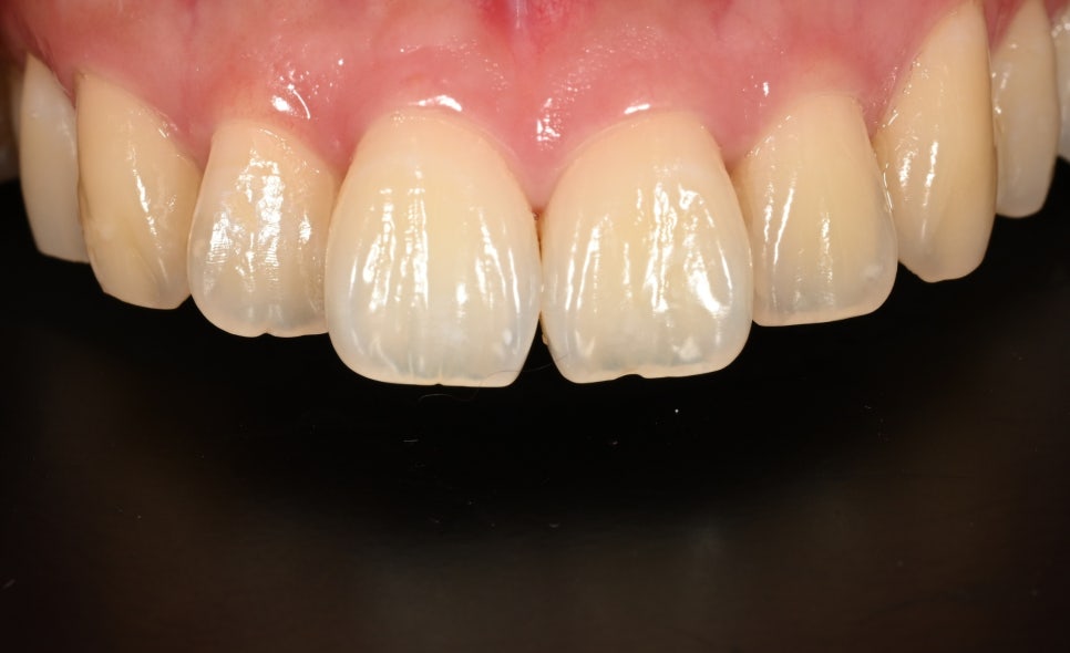 Jamsil Veneers: Worried About Rabbit Teeth? image 1