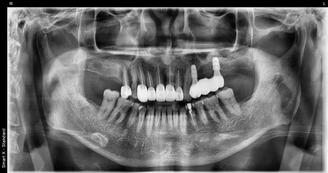 A Broken Front Tooth from a Fall, Restored Along with the Gums! Emergency Treatment Report from Seoul Ob Dental Hospital image 12