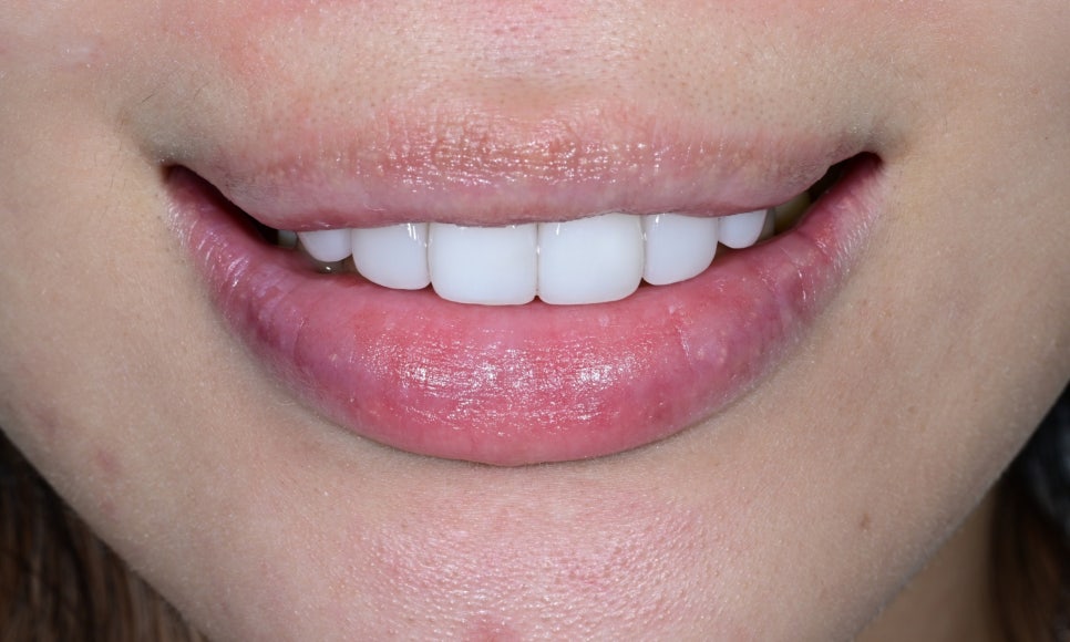 Jamsil Veneers: Worried About Rabbit Teeth? image 10