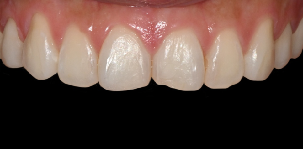 Natural-looking Front Teeth Completed with Laminate Veneers in Jamsil image 4