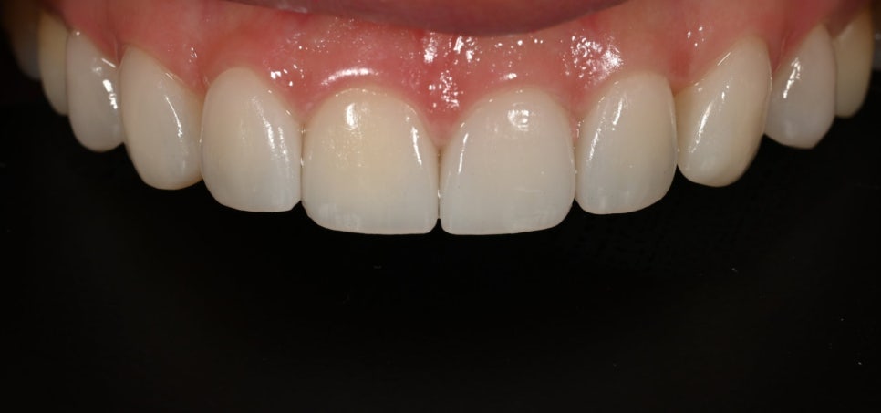 Tooth Wear: Resin? Veneers Are Also an Option image 7