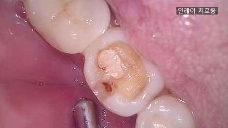 Inlay Treatment Review in Songpa-gu, Seoul – Completed in 1 Week with Precision Scanning and Lab Work image 5