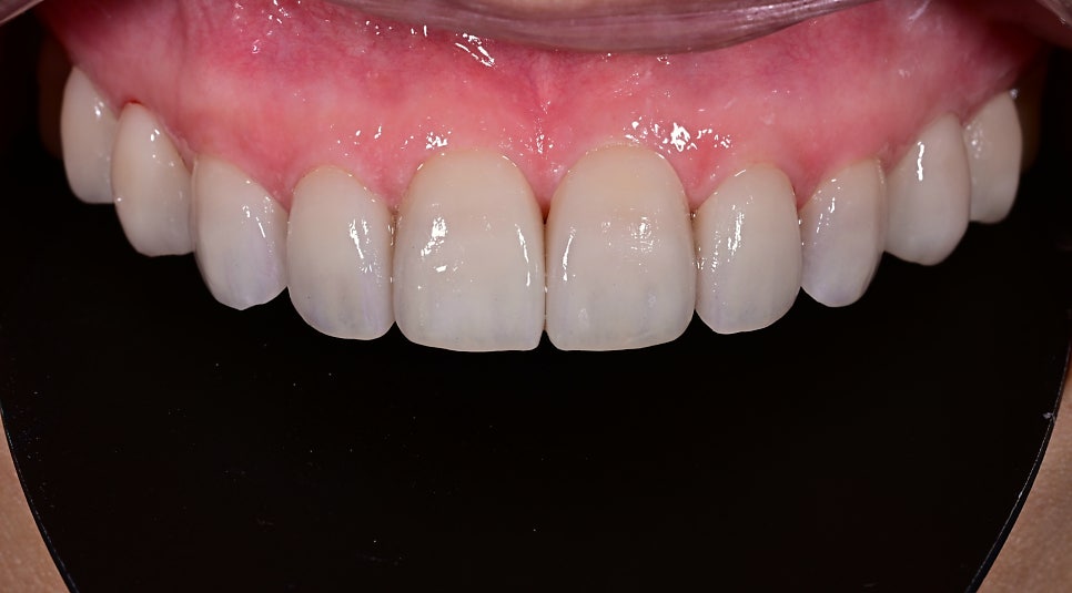Objet Laminate Treatment for Seniors: Naturally Beautiful, Without Tooth Reduction image 14