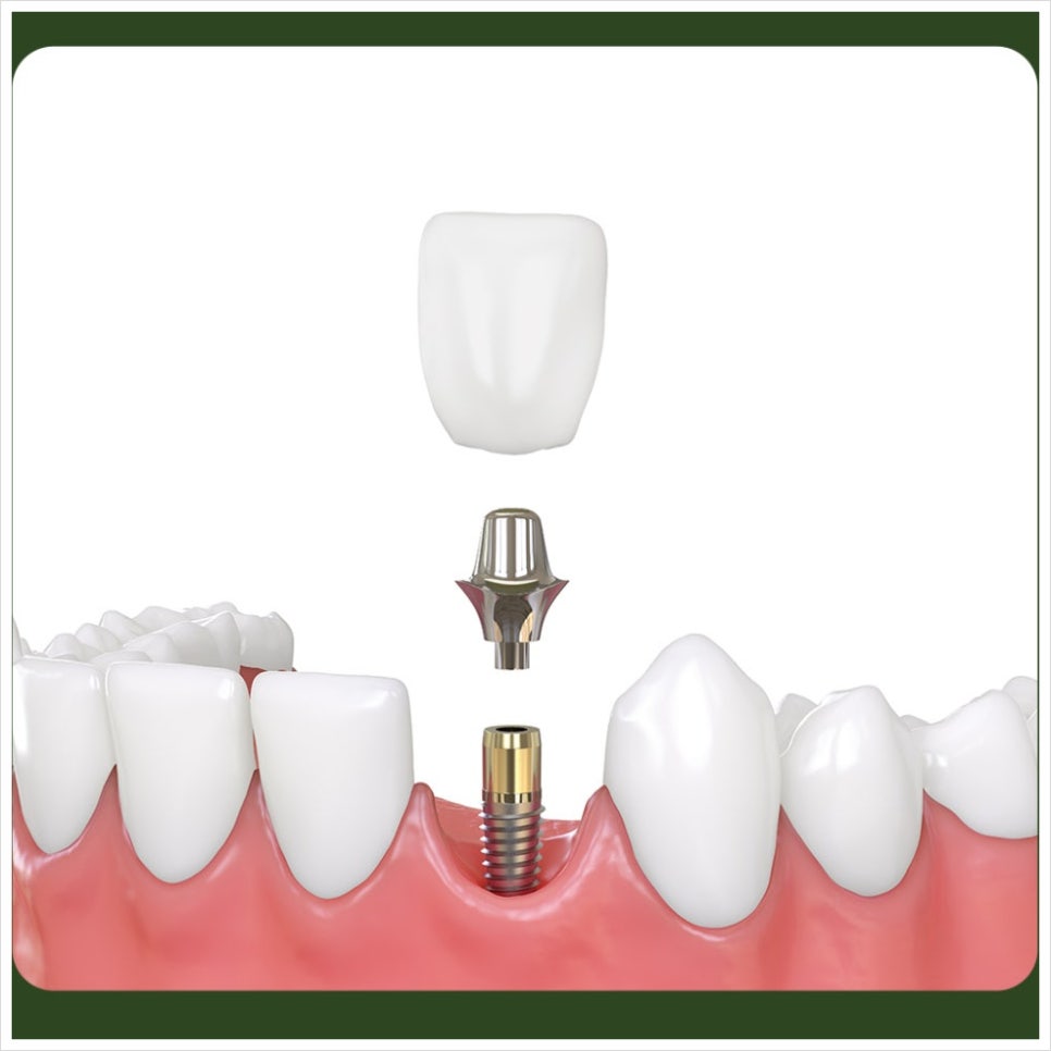 Why Should You Be Careful About Drinking After an Implant? image 2