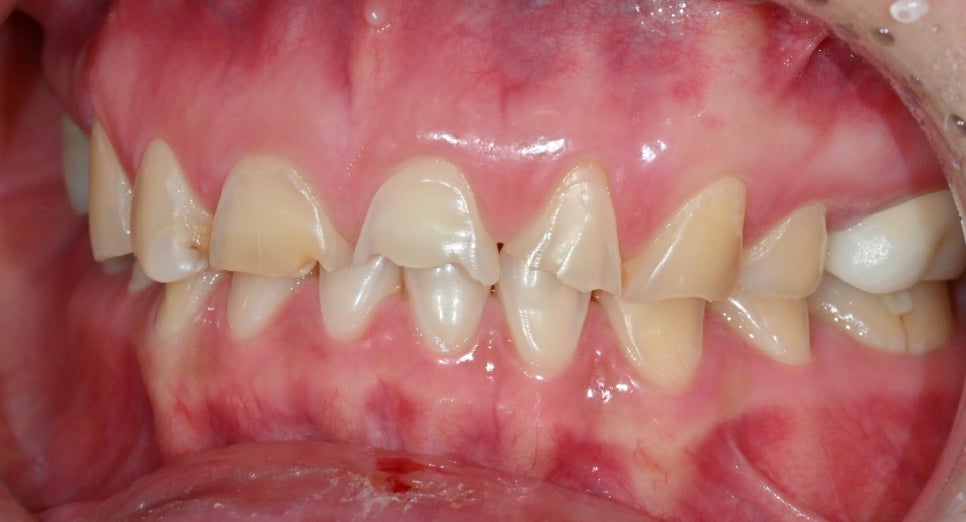 Treatment with Objetto Laminate Veneers After a Chipped Front Tooth image 2