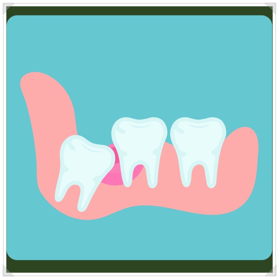 Wisdom Tooth Inflammation: Don’t Leave It Alone—Please Have It Removed! image 5