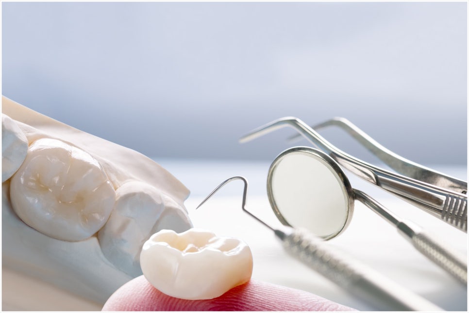 Why Is a Crown Placed After Root Canal Treatment? image 7
