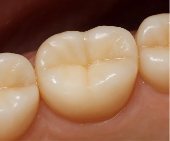 Jamsil Dental Clinic Zirconia Crown Price image 1