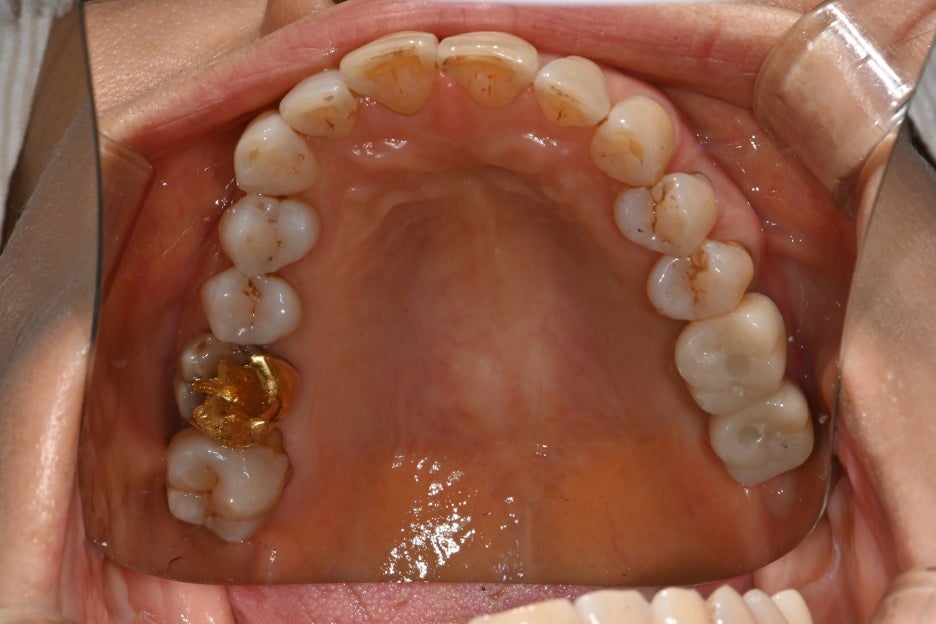 Songpa Dental Clinic: Is Insurance-Covered Implant Treatment Possible? image 24