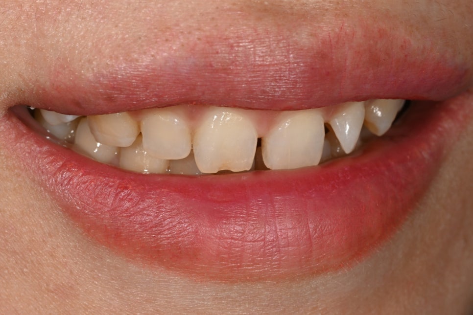 Can Gaps Between the Front Teeth Be Treated with Composite Resin? A Case Treated with Veneers image 6