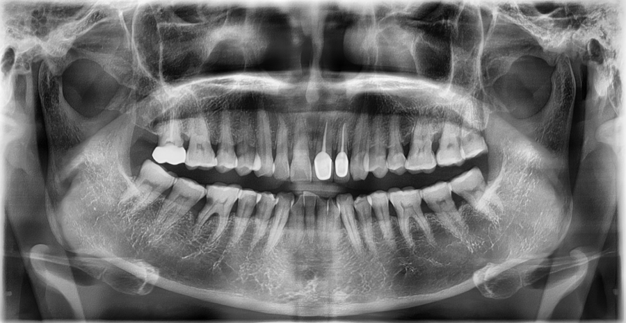 How Was Sensitivity and Discomfort Resolved After Implant Treatment in Jamsil? image 1