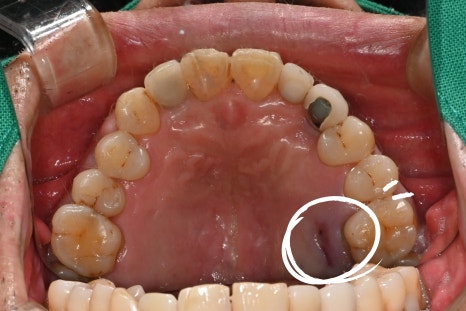 어금니 임플란트가격, 임플란트치과에서 진행한 실제 치료 과정 관련 이미지 8