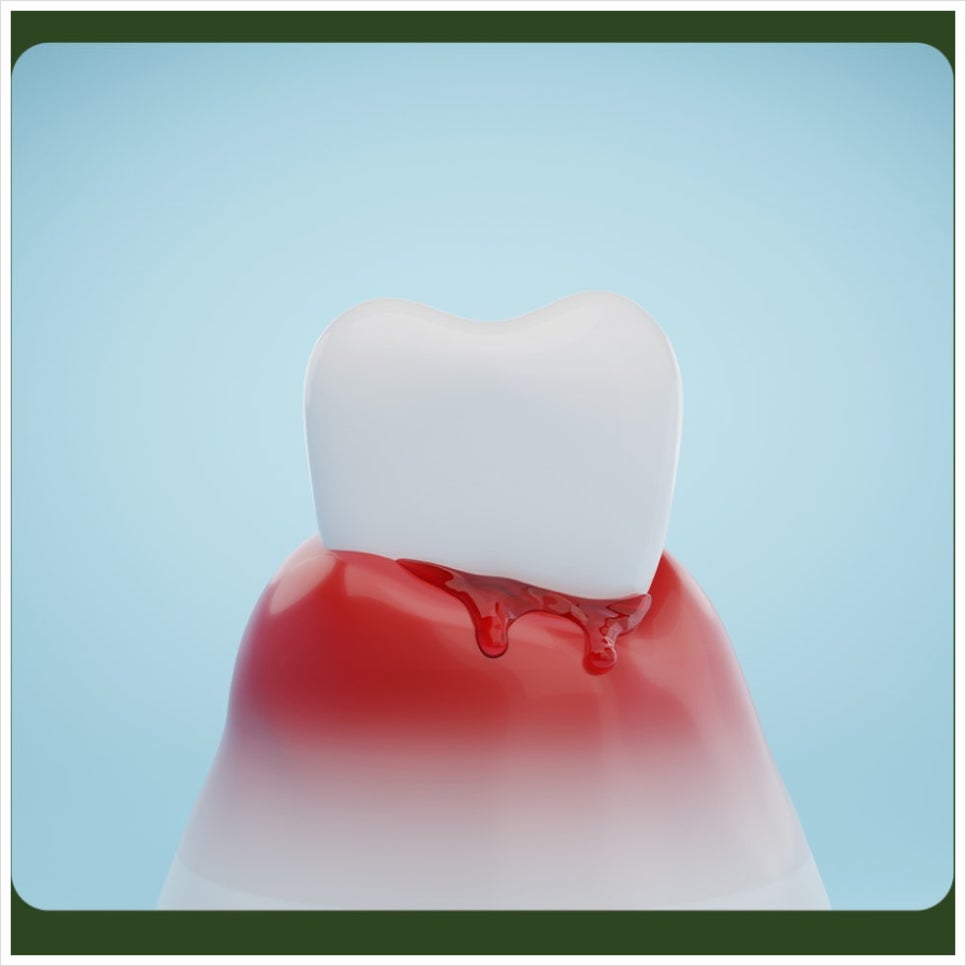 Bleeding When Using Dental Floss: Can You Keep Using It? image 4