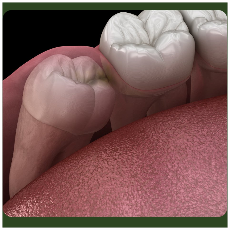 After Wisdom Tooth Extraction: What Should You Watch for With Bleeding Control? image 4