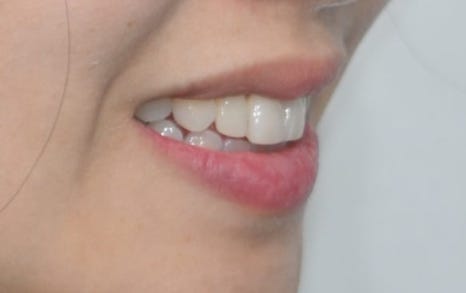 Laminate Veneers for Protruding Teeth: If They’re Too Thick, They Look Even More Prominent image 6