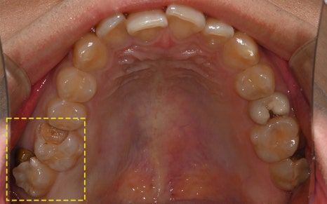 Samjeon Station Implant: Why do some break while others can last a lifetime? image 9