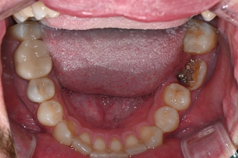 Implant Treatment Available for Foreign Residents Abroad! A Case Completed Perfectly Within 3 Months image 3
