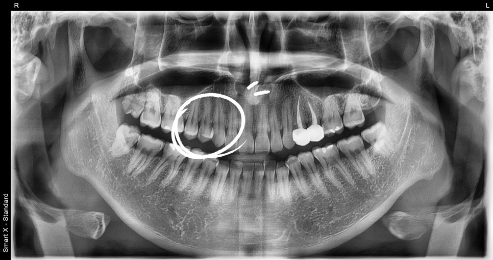 Why Cracked Molar Pain Means You May Need Root Canal Treatment image 4