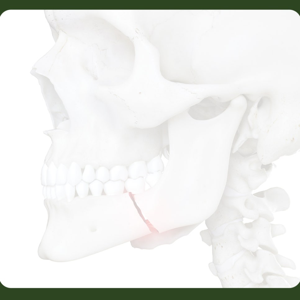 If Your Jaw Is Fractured, What Should You Do? image 4