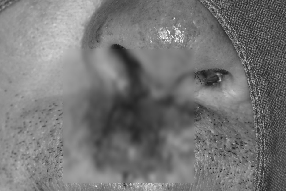 Songpa Dental Clinic: Man in His 70s Fell on Sidewalk Blocks, Requiring Laceration Suturing and Implant Surgery image 8