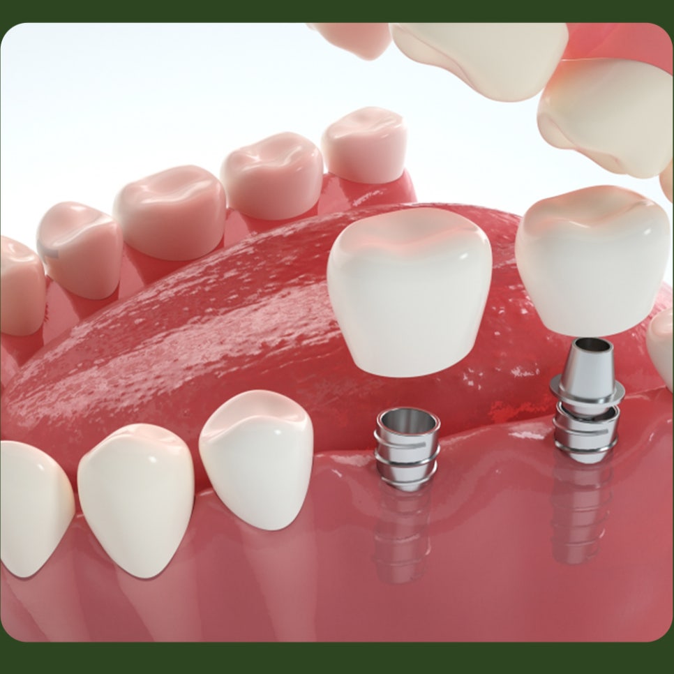Please Be Careful with Smoking After Dental Implants! image 5