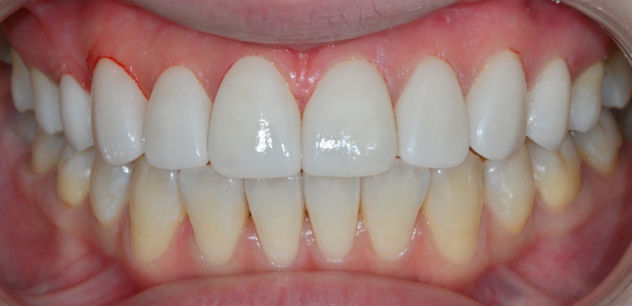 Jamsil no-prep laminate veneers: a real case of changing the impression without filing down the teeth image 16