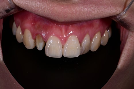 How We Naturally Improved an Upper Front Tooth Crown Retreatment, Including Color Differences and the Gum Line image 10