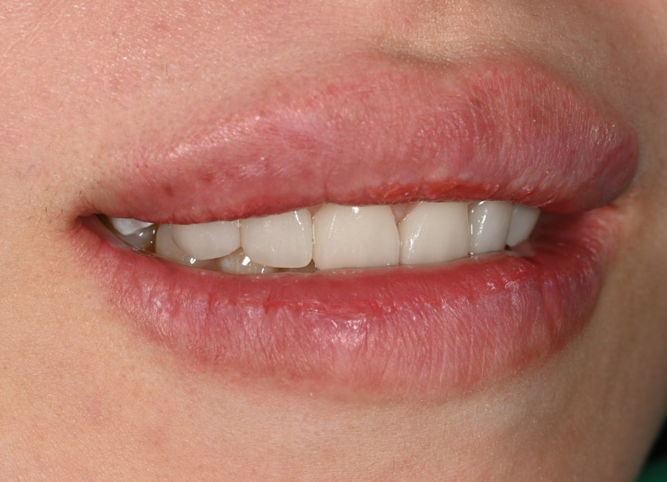 Can Gaps Between the Front Teeth Be Treated with Composite Resin? A Case Treated with Veneers image 8