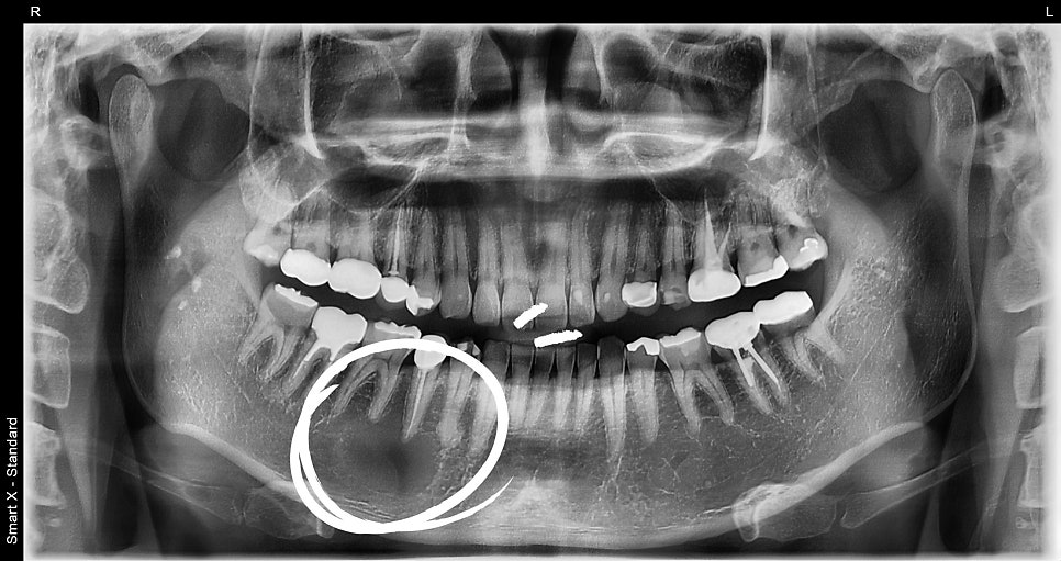 About Jawbone Benign Tumors and IV Sedation at Samjeon Station Dental Clinic image 5