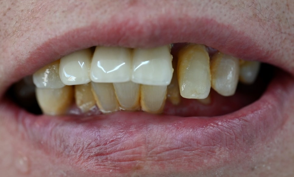 How Are Snap-On Dentures and Full-Mouth Implant Costs Handled at an Implant Dental Clinic? image 14