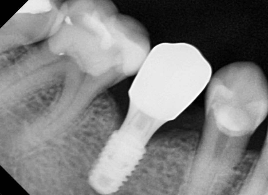 Songpa Dental Clinic: Implant After Molar Extraction image 15