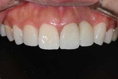 Possible Front Tooth Prosthetic Replacement Even While Staying Abroad! A Natural Smile Completed on a Short Schedule✨ image 3