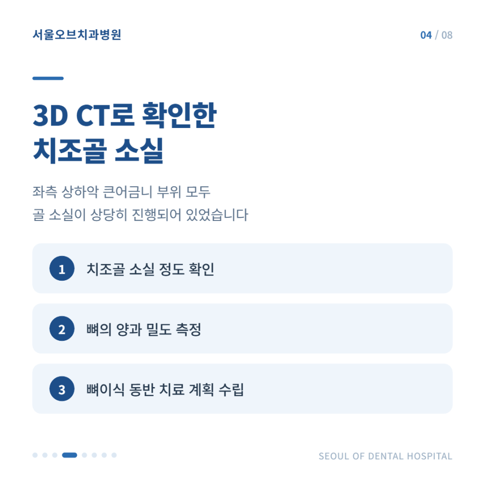 잠실임플란트 치주염으로 흔들리던 어금니, 오스템임플란트 수복 사례 관련 이미지 5