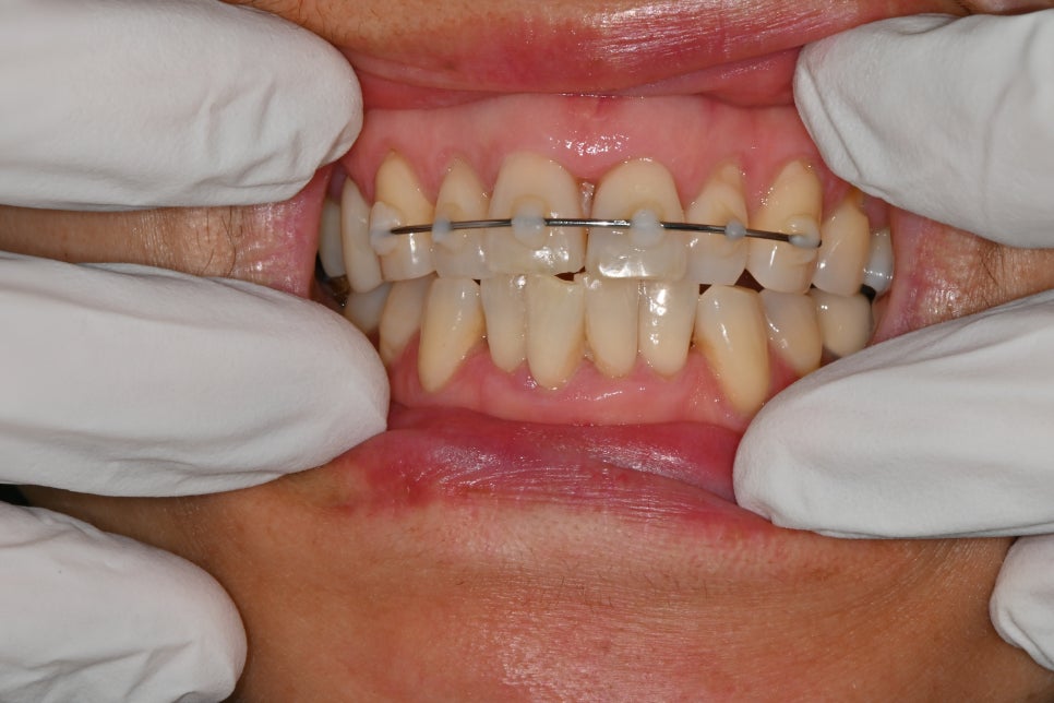 Treatment Process Revealed for a Fall That Injured Both the Front Teeth and Lip image 15