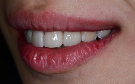 Objeo Laminate Cost, Treatment Review from a Woman in Her 20s image 11