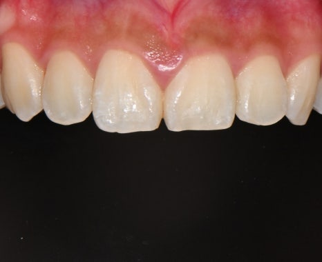 Samjeon Station Dental Clinic: "Without Orthodontics, Object Zero for the Smile Line of a Woman in Her 20s" image 4